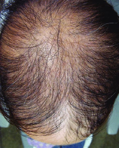 Clinical Picture At 2 Weeks From The Onset Of Hair Shedding Download