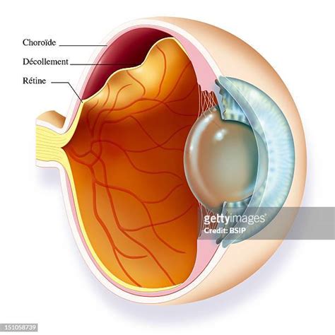 Retinal Detachment Photos And Premium High Res Pictures Getty Images