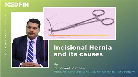 Incisional Hernia What Is The Cause And What Are The Symptoms Youtube