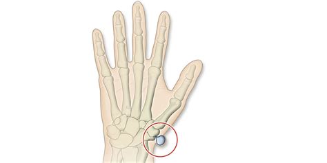 Durch die verkürzung gibt es auf der daumenseite zwischen hand und unterarm einen knick nach innen. Handgelenksganglion (Überbein) | Apotheken Umschau
