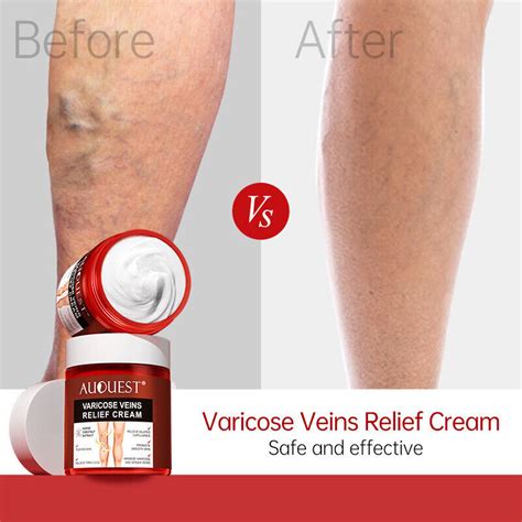 Effective Varicose Veins Relief Cream Relieve Vasculitis Phlebitis