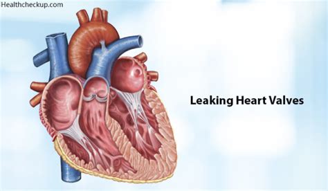 Leaking Heart Valves Life Expectancy Causes Signs Treatment By Dr