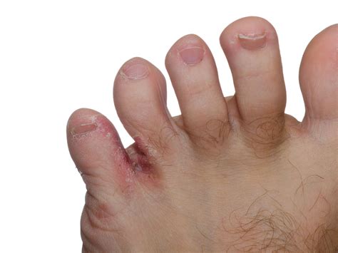Common Fungal Infections Athletes Foot Epiphany Dermatology