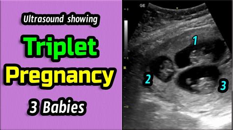 Ultrasound Showing Triplet Pregnancy Youtube