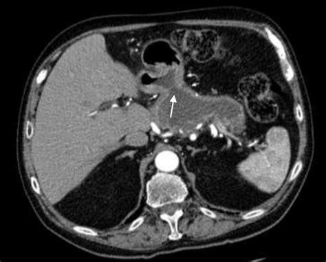 Axial Contrast Enhanced Ct Of The Abdomen In June 2018 Demonstrates A