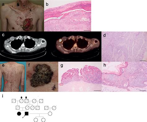 Aggressive Squamous Cell Carcinoma In A Case Of Epidermodysplasia Verruciformis Carrying A TMC