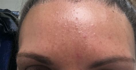 Small Colourless Bumps On My Forehead General Acne Discussion Acne