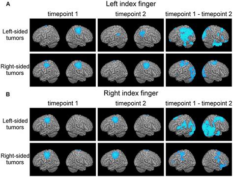 Frontiers Motor Cortical Network Plasticity In Patients With