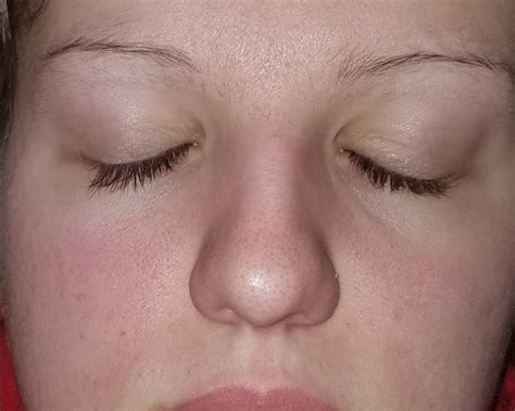 Images Of Lupus Rash On Face