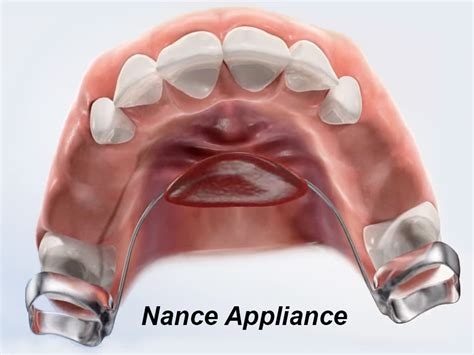 What Is A Nance Appliance And When Should You Use It