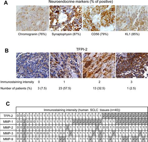 Immunohistochemistry Analysis Of Small Cell Lung Cancer Samples SCLC