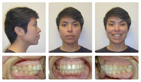 Braces Under Bite Adult Before And After
