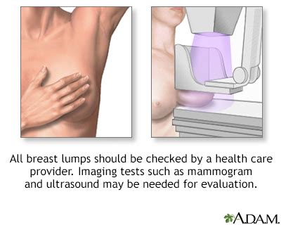 Breast Lump Uf Health University Of Florida Health