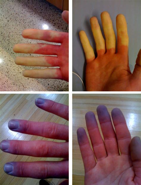 Its Not Lupus Lupus Guide For The Perplexed Raynauds Phenomenon