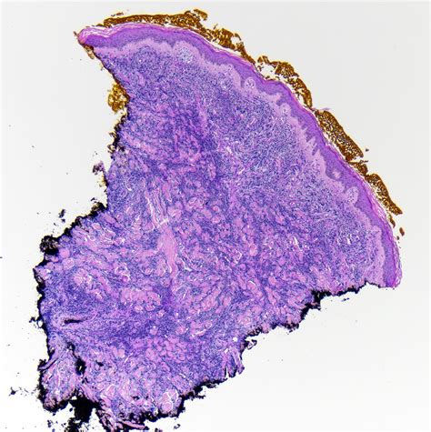 Pathology Outlines Diffuse Large B Cell Lymphoma Leg