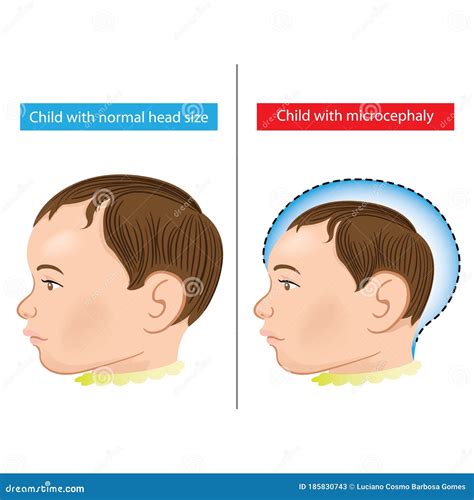 Illustration Of A Newborn Baby With Microcephaly Disease Caused By Zika