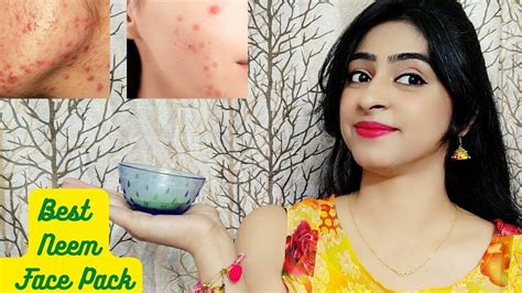 Remove Pus Filled Acne And Pimples Overnight Get Rid Of Pimple Acne Permanently Youtube