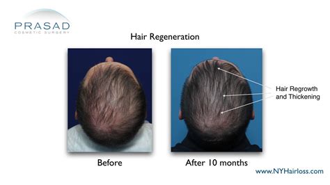 Case Study Late Onset Hair Loss Treatment Without Finasteride