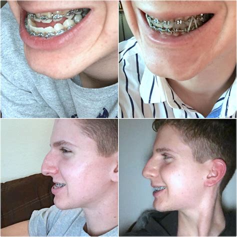 What To Eat After Tooth Extraction Reddit Tiara Transformation Review