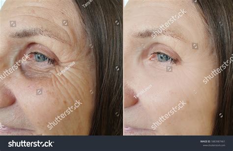 Woman Face Wrinkles Before After Treatment Stock Photo Edit Now