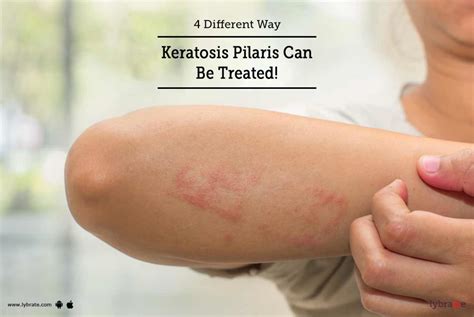 4 Different Way Keratosis Pilaris Can Be Treated By Dr Purvi C Shah