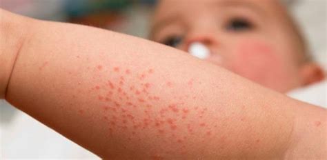 Hard Water Linked To Risk Of Itchy Red Rash In Infants Instamag