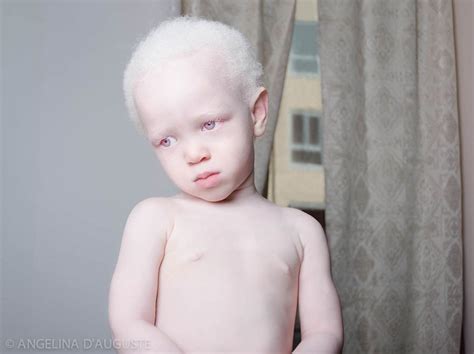 Zdj Ludzi Cierpi Cych Na Albinizm Wygl Daj Jak Duchy A Ci Ko