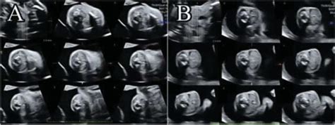 Three Dimensional Ultrasound In The Tomographic Ultrasound Imaging Mode