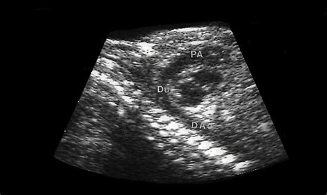 Level Ii Ultrasound The Fetal Thorax