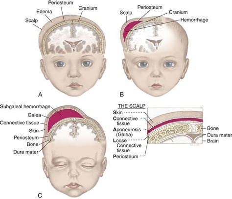 Differences Between Caput Succedaneum Cephalhematoma And Subgaleal