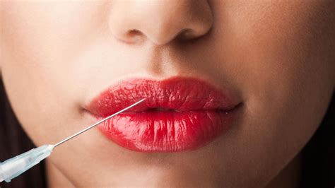 Lip fillers are a type of dermal filler. Lip Injections Are Most Popular in This City | Allure