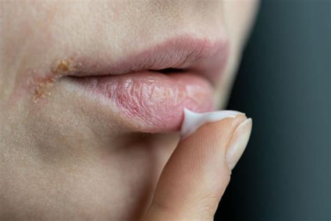 Eingerissene Mundwinkel Ursachen Und Tipps BRIGITTE De