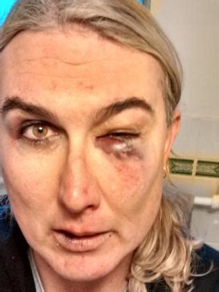 Transgender Sydney Musician Stephanie Mccarthy Bashed At Town Hall Hotel In Newtown Daily