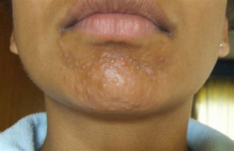 Small Bumps On Chin Scars Milia Fungal Infection General Acne