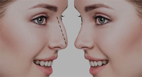 Know All The Types Of Unshaped Noses And Undergo Rhinoplasty