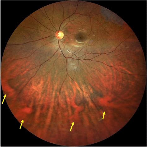 Widefield Color Fundus Image Of The Left Eye In A Healthy Patient