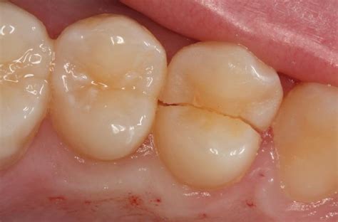 Cracked Teeth What They Are And Treatment You Need For Them