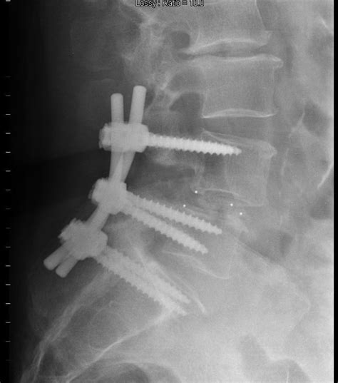 Cirugía para la estenosis vertebral lumbar canal espinal
