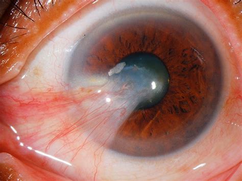 What Is A Pterygium Definition Causes And Treatment