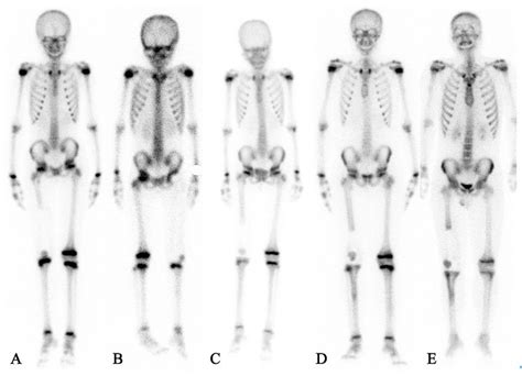 Bone Scintigraphy Findings After Surgery For Different Prosthetic