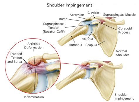 S C Blog Subacromial Impingement Pain Syndrome