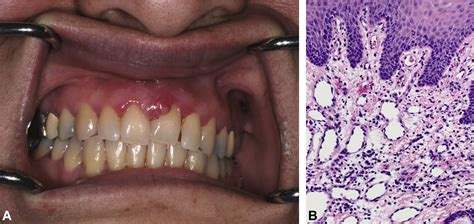 Benign Oral Mucosal Lesions Clinical And Pathological Findings