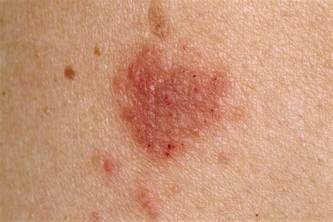 Atopic Dermatitis Prevalence 73 In Us Adults Pulmonology Advisor