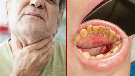 Signs Of Oral Cancer On Tongue