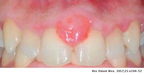 Oral Pyogenic Granuloma Diagnosis And Treatment A Series Of Cases