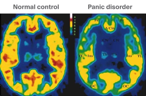 Pet Scan Measuring Gaba A Receptors In Normal Brain And In People With
