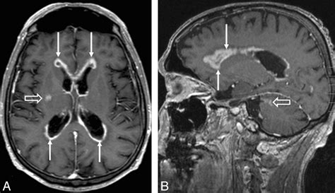 Central Nervous System Lymphoma Characteristic Findings On Traditional