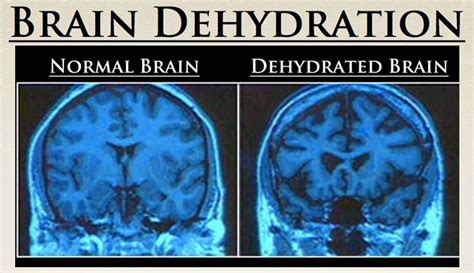 Brain Dehydration A Picture Of A Normal Vs Dehydrated Brain 脳 健康