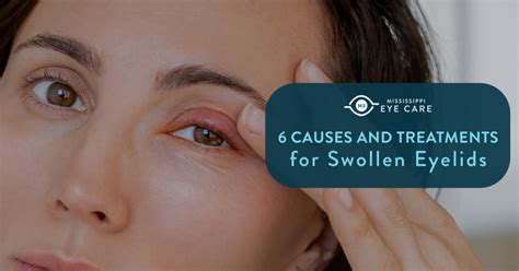 6 Causes And Treatments For Swollen Eyelids Mississippi Eye Care