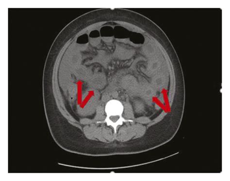 Abdominal Ct Scan Showing Small Bowel Thickening A Bilateral